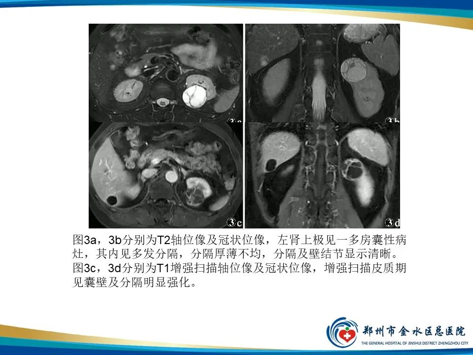 【PPT】黄色肉芽肿性肾盂肾炎影像表现-40