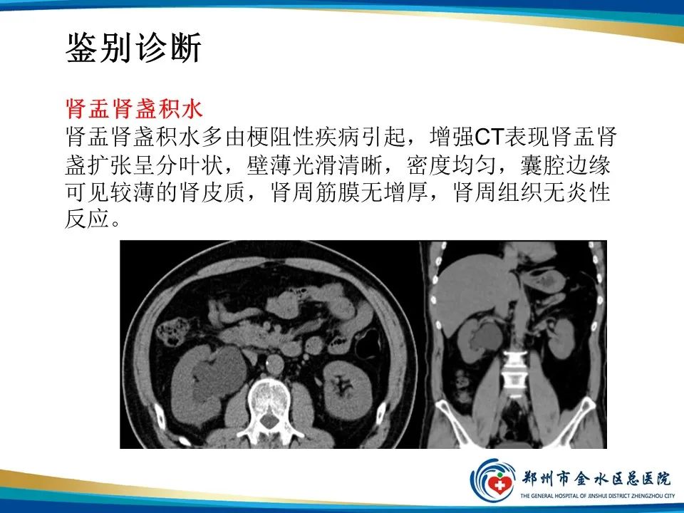 【PPT】黄色肉芽肿性肾盂肾炎影像表现-41
