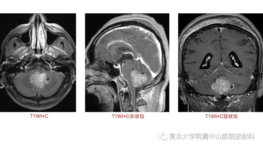 【病例】成人四脑室髓母细胞瘤2例CT及MR-4