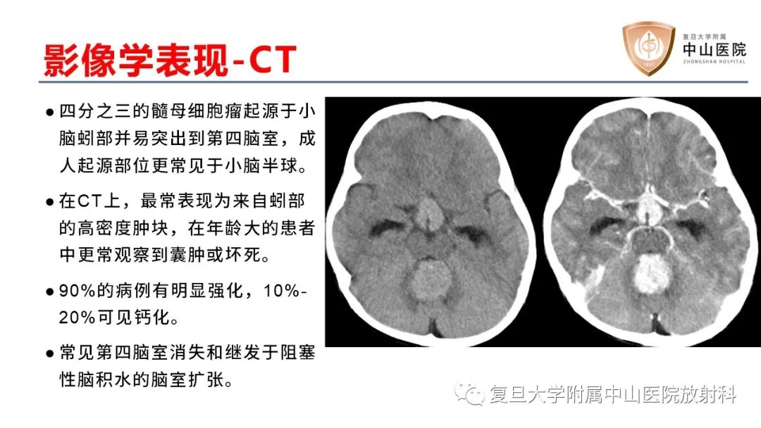 【病例】成人四脑室髓母细胞瘤2例CT及MR-13