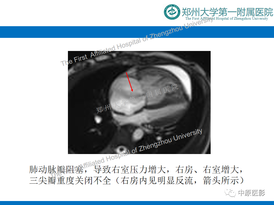 【病例】心脏血管瘤1例MR影像-5
