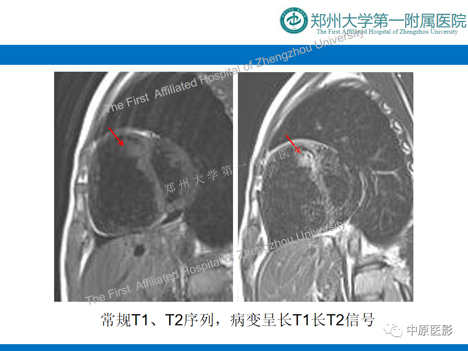 【病例】心脏血管瘤1例MR影像-4