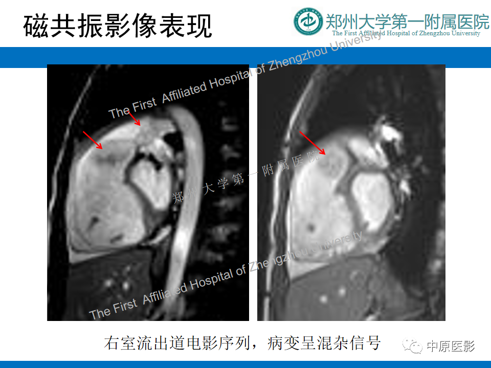 【病例】心脏血管瘤1例MR影像-3
