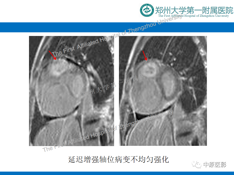 【病例】心脏血管瘤1例MR影像-6