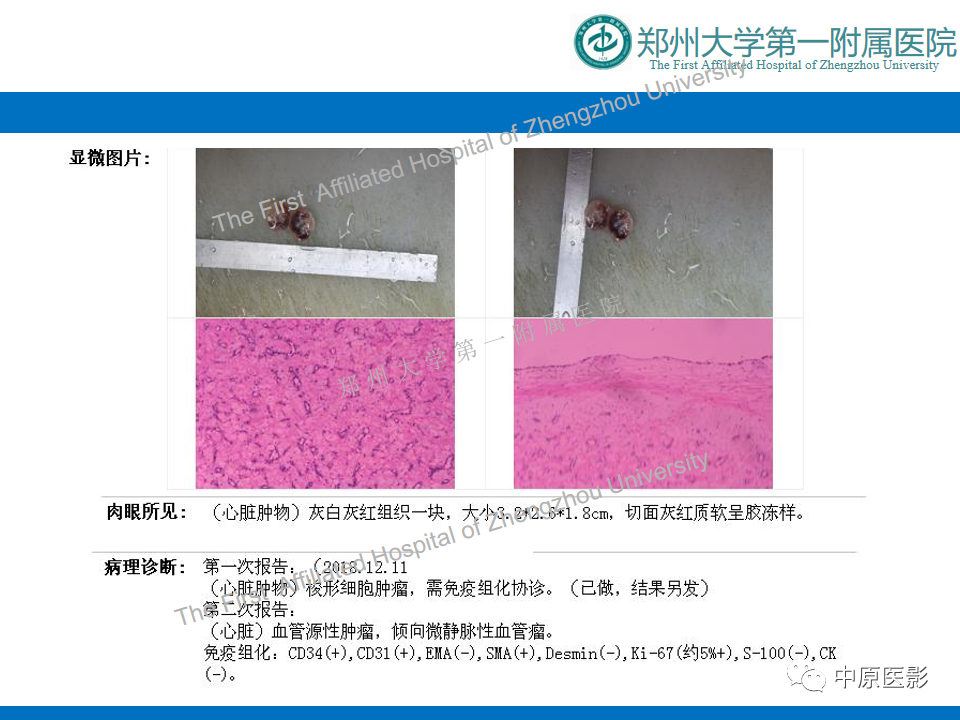 【病例】心脏血管瘤1例MR影像-8