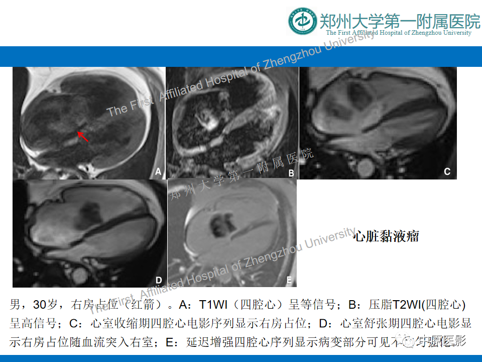 【病例】心脏血管瘤1例MR影像-12
