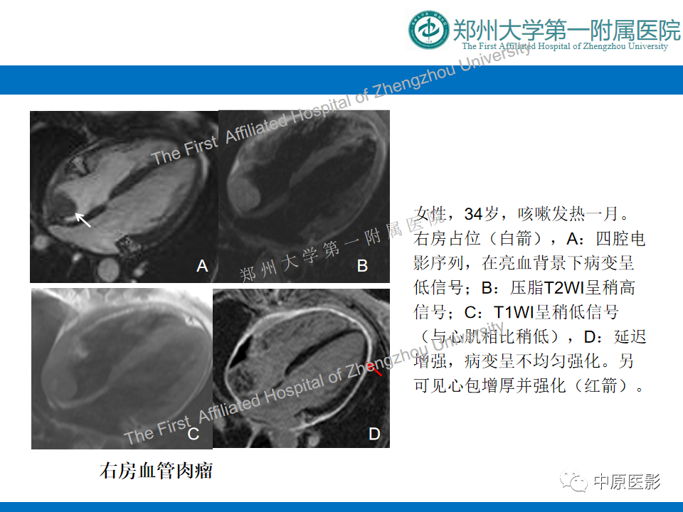 【病例】心脏血管瘤1例MR影像-14