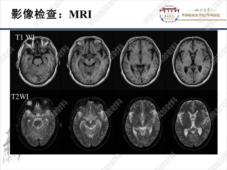 【PPT】颅咽管瘤1例MR影像鉴别诊断-4