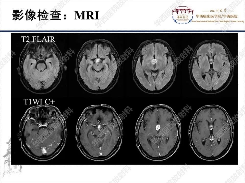 【PPT】颅咽管瘤1例MR影像鉴别诊断-5