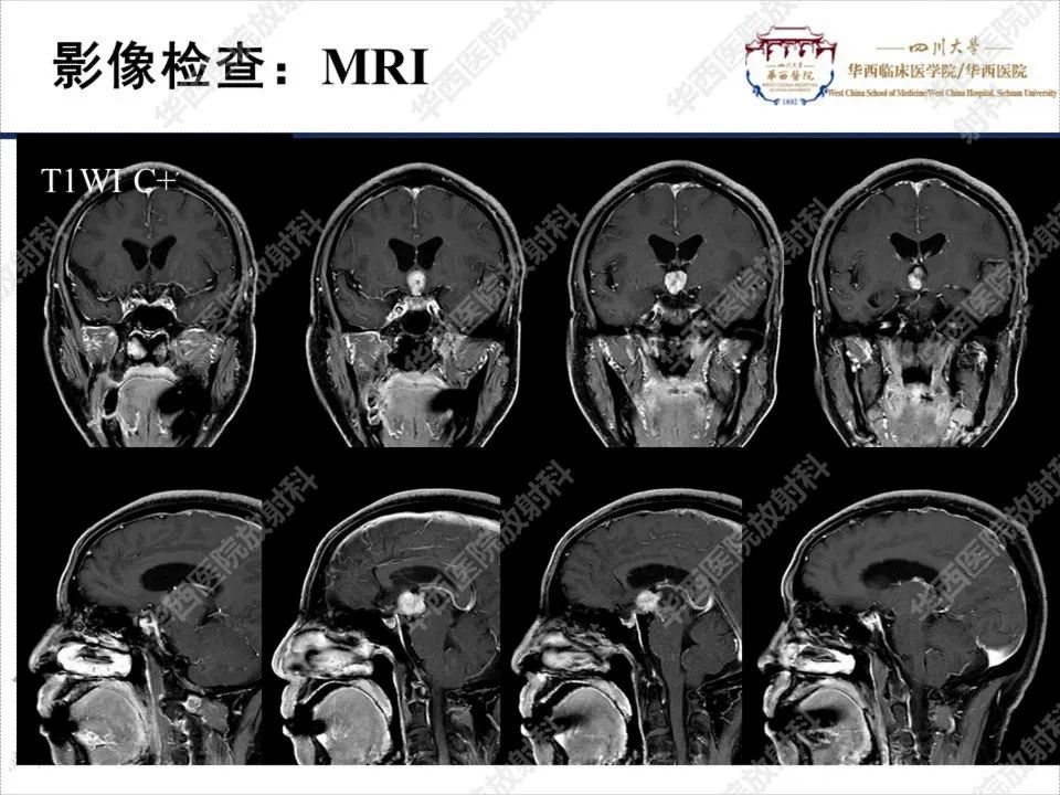 【PPT】颅咽管瘤1例MR影像鉴别诊断-6