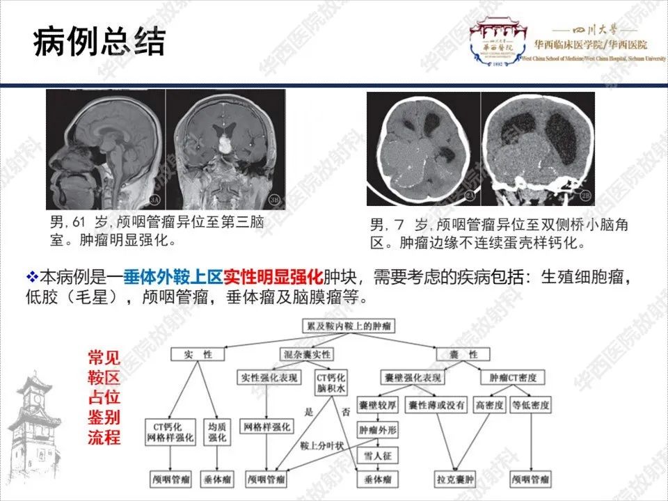 【PPT】颅咽管瘤1例MR影像鉴别诊断-11