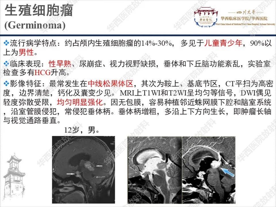 【PPT】颅咽管瘤1例MR影像鉴别诊断-13