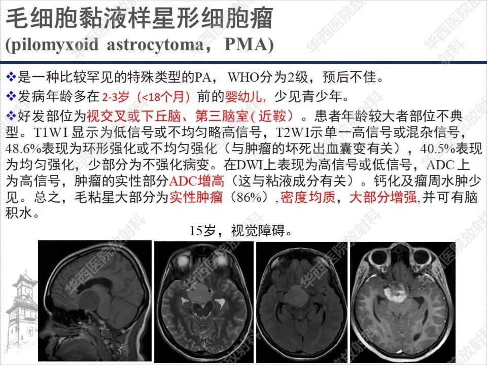【PPT】颅咽管瘤1例MR影像鉴别诊断-15