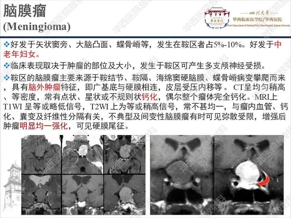 【PPT】颅咽管瘤1例MR影像鉴别诊断-16