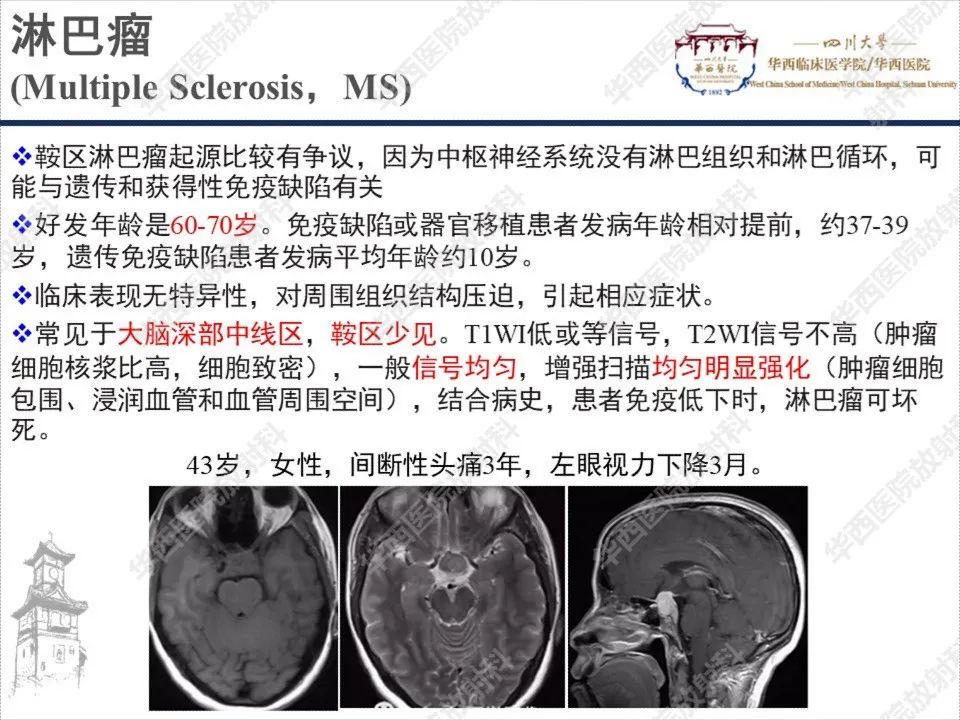 【PPT】颅咽管瘤1例MR影像鉴别诊断-17