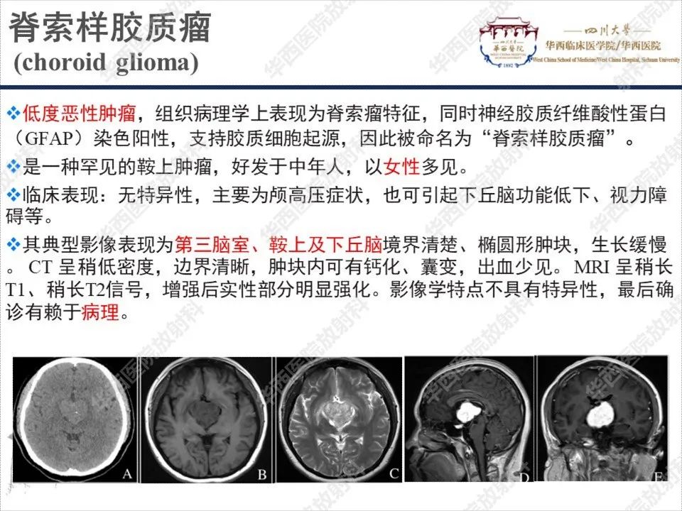 【PPT】颅咽管瘤1例MR影像鉴别诊断-18