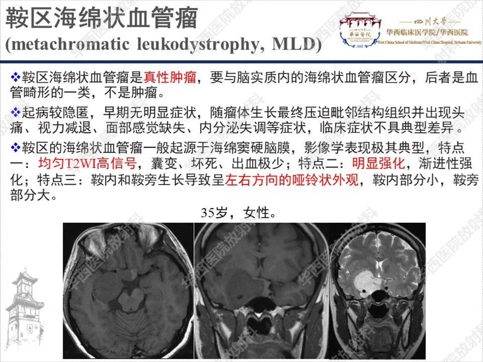【PPT】颅咽管瘤1例MR影像鉴别诊断-19