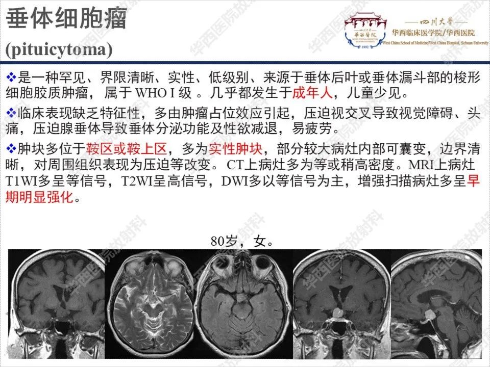 【PPT】颅咽管瘤1例MR影像鉴别诊断-20