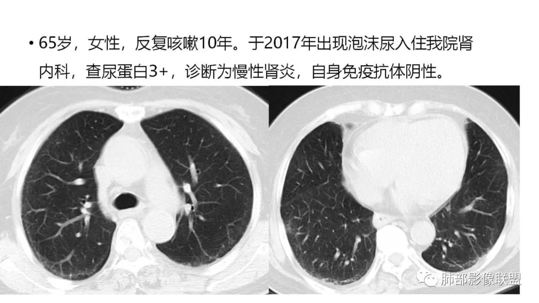 【PPT】肺粘液腺癌—一种疾病，两种表现-2