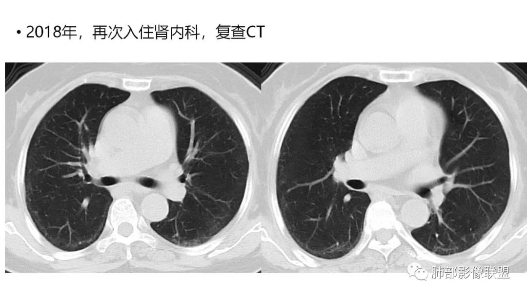 【PPT】肺粘液腺癌—一种疾病，两种表现-4