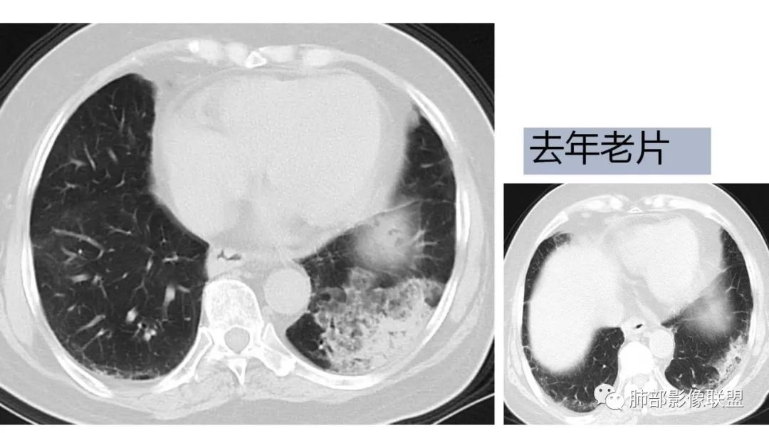 【PPT】肺粘液腺癌—一种疾病，两种表现-5