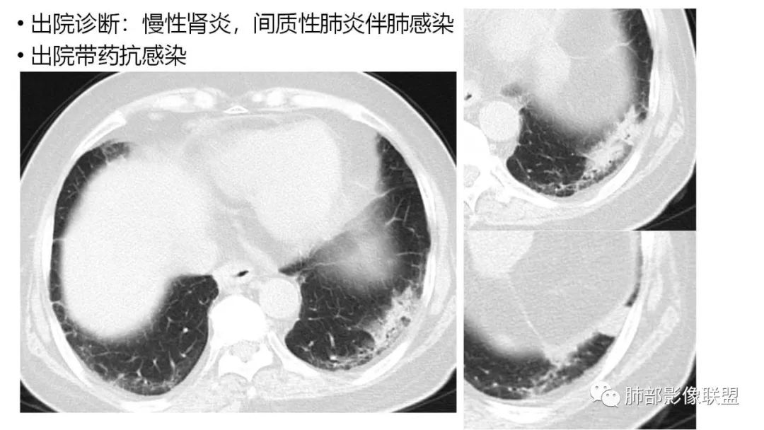 【PPT】肺粘液腺癌—一种疾病，两种表现-3