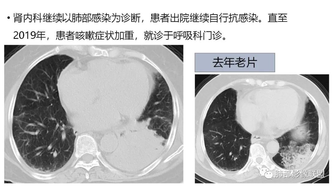 【PPT】肺粘液腺癌—一种疾病，两种表现-6