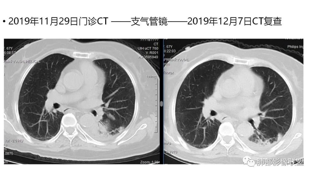 【PPT】肺粘液腺癌—一种疾病，两种表现-8