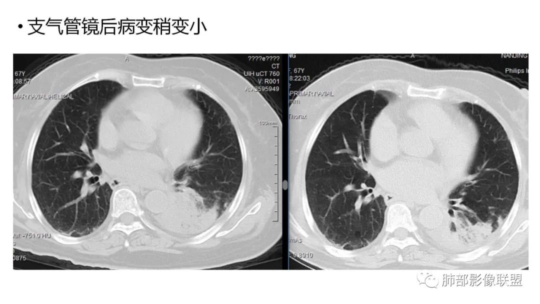 【PPT】肺粘液腺癌—一种疾病，两种表现-9