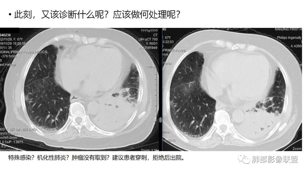 【PPT】肺粘液腺癌—一种疾病，两种表现-10
