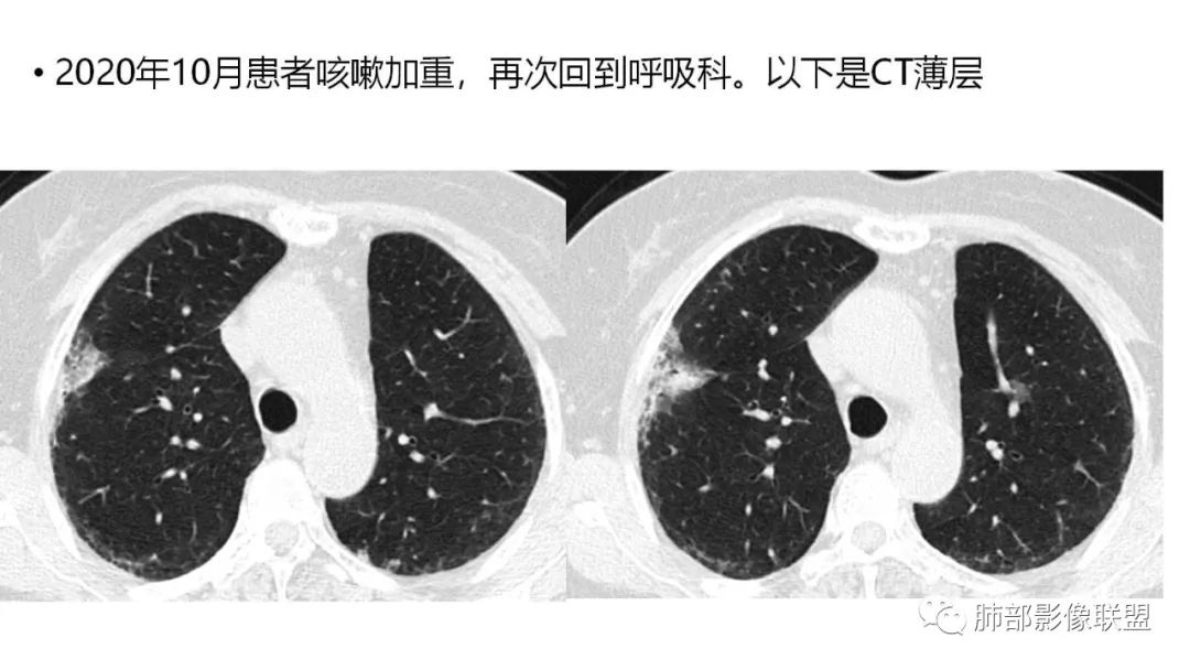 【PPT】肺粘液腺癌—一种疾病，两种表现-11