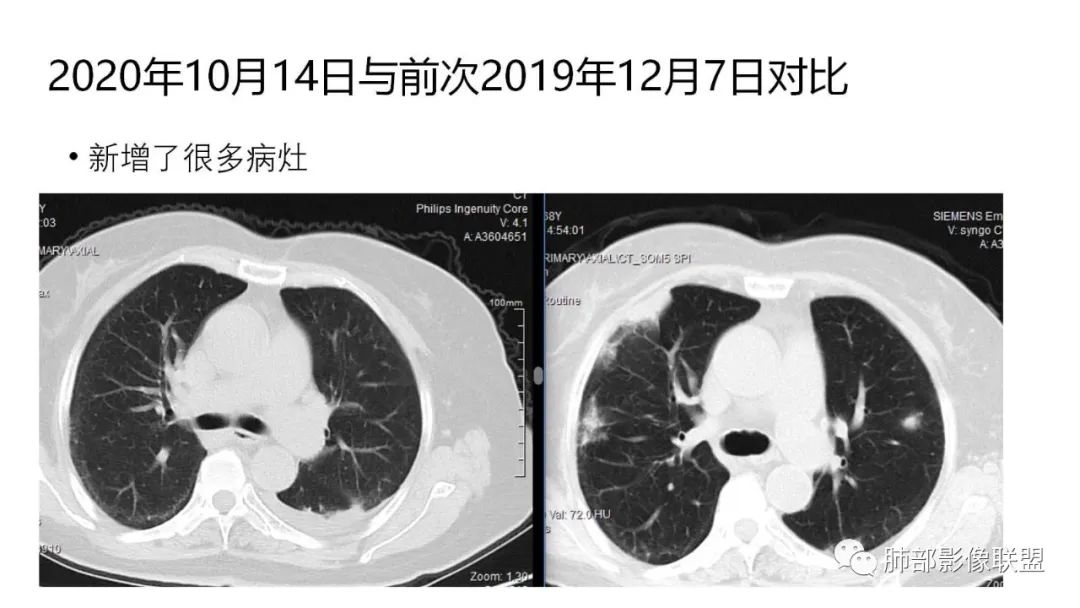 【PPT】肺粘液腺癌—一种疾病，两种表现-25