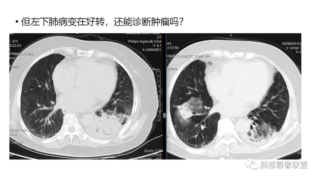 【PPT】肺粘液腺癌—一种疾病，两种表现-26
