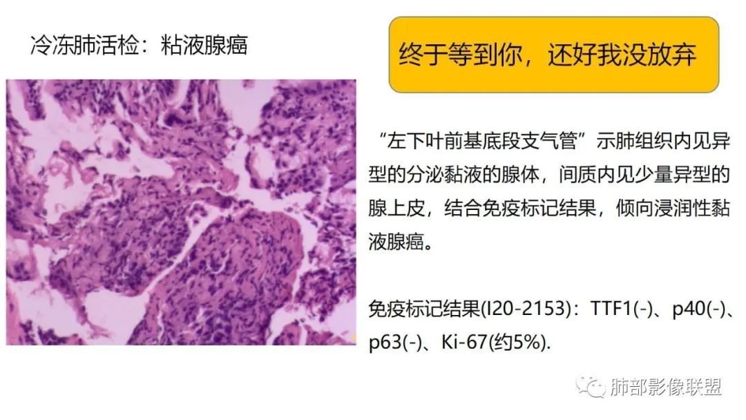 【PPT】肺粘液腺癌—一种疾病，两种表现-28