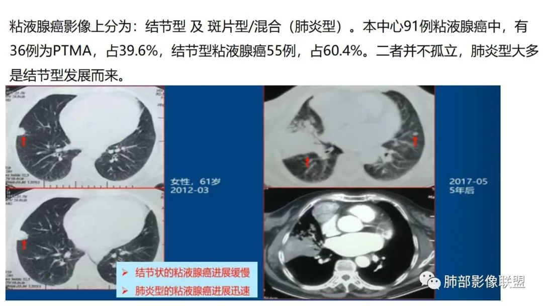 【PPT】肺粘液腺癌—一种疾病，两种表现-32