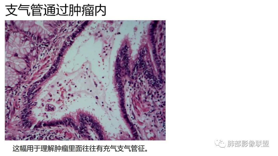 【PPT】肺粘液腺癌—一种疾病，两种表现-42