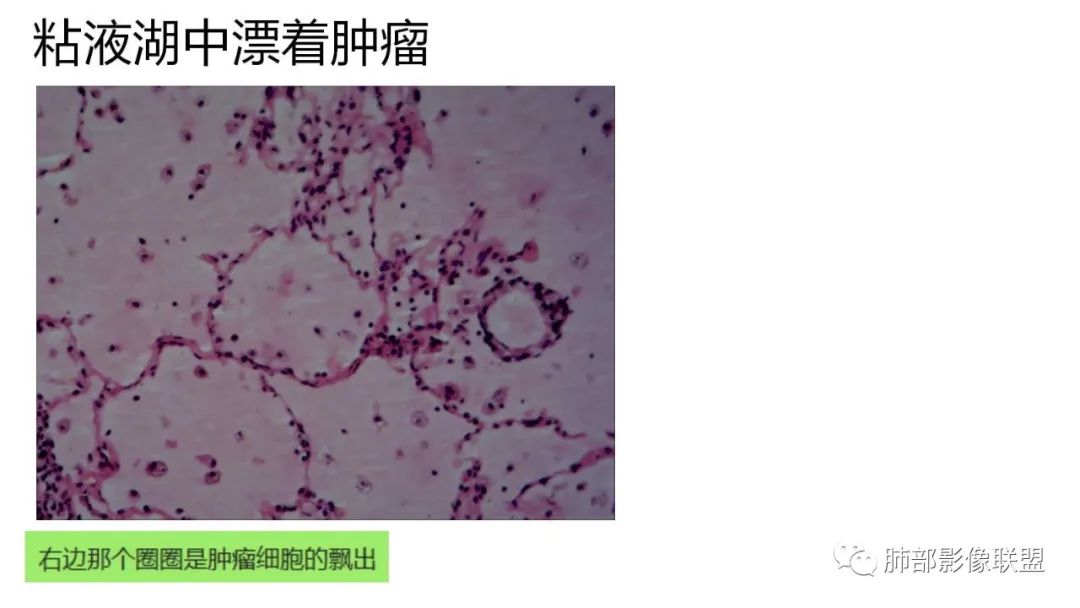 【PPT】肺粘液腺癌—一种疾病，两种表现-43