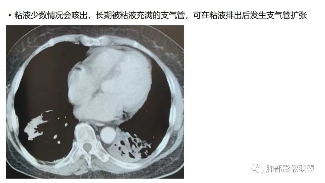 【PPT】肺粘液腺癌—一种疾病，两种表现-48