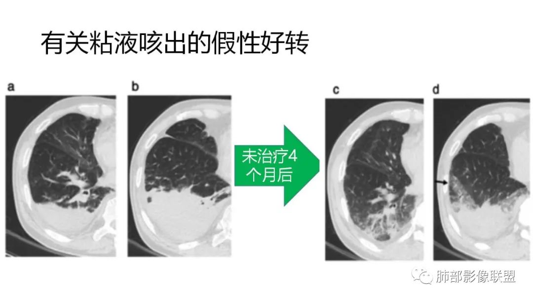 【PPT】肺粘液腺癌—一种疾病，两种表现-49