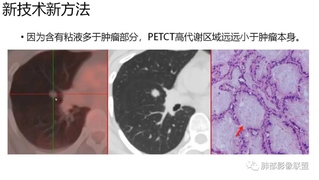 【PPT】肺粘液腺癌—一种疾病，两种表现-50