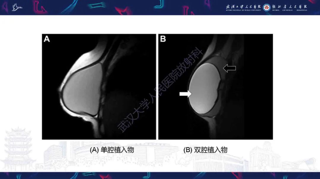 【PPT】隆胸术后并发症MRI诊断-5