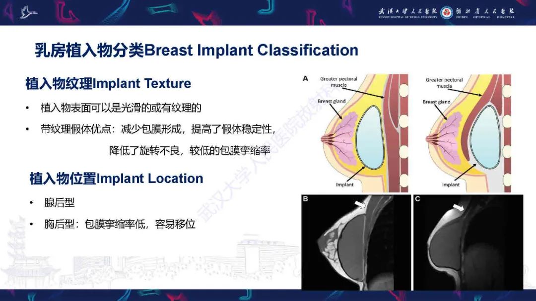 【PPT】隆胸术后并发症MRI诊断-6