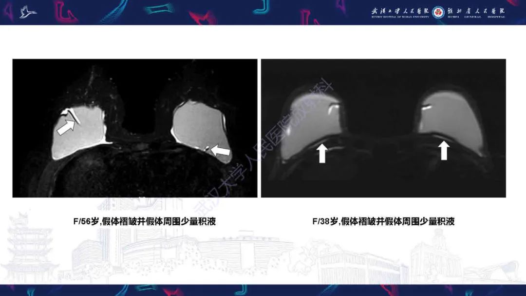 【PPT】隆胸术后并发症MRI诊断-11