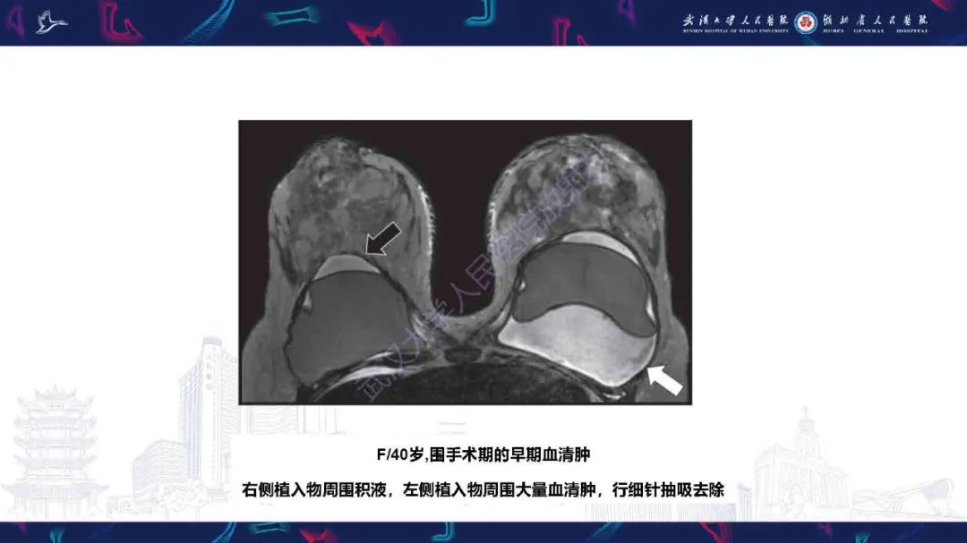 【PPT】隆胸术后并发症MRI诊断-15