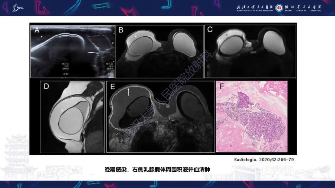 【PPT】隆胸术后并发症MRI诊断-16