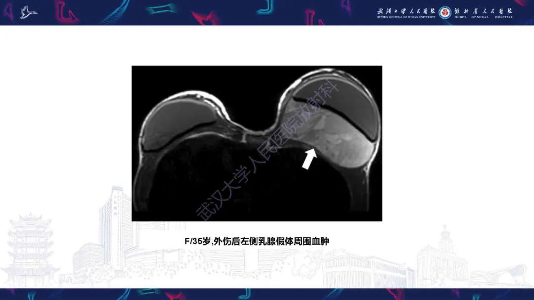 【PPT】隆胸术后并发症MRI诊断-17
