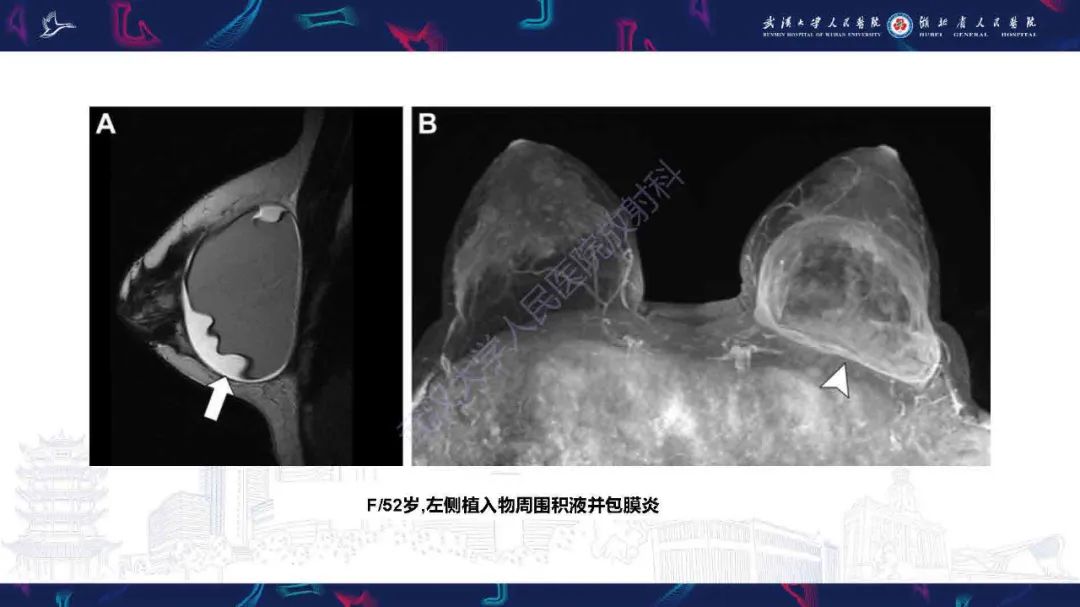 【PPT】隆胸术后并发症MRI诊断-19