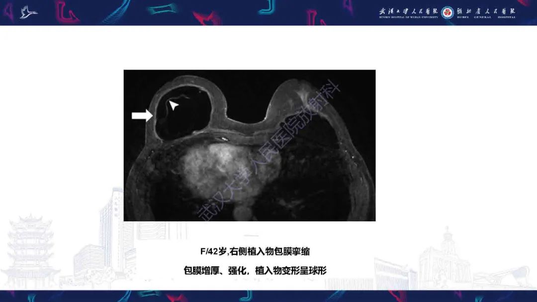 【PPT】隆胸术后并发症MRI诊断-21