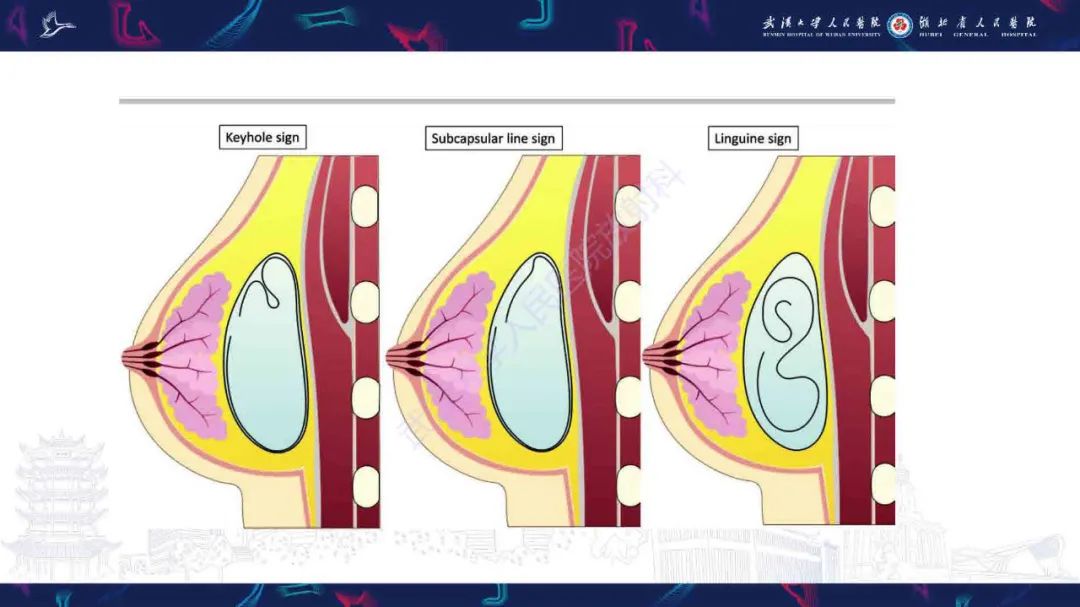 【PPT】隆胸术后并发症MRI诊断-26