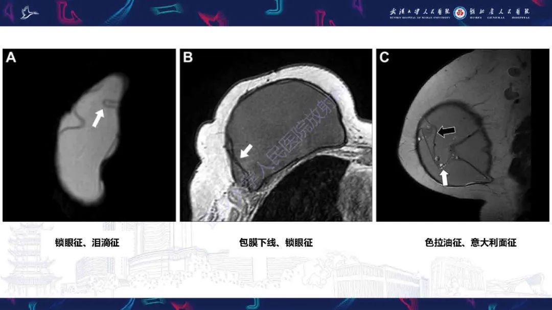 【PPT】隆胸术后并发症MRI诊断-27